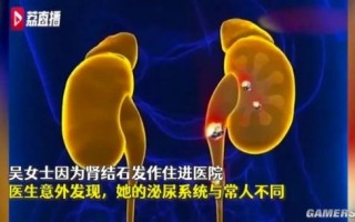 女子天生4条输尿管、4个肾 竟全部长结石