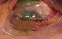 女子眼中取出23枚隐形眼镜 自称每天忘记是否摘掉