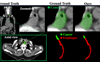 AI 与 CT 首次结合可查早期食管癌，阿里达摩院新技术有望在常规体检中落地