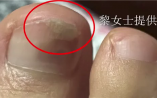 女子长期未卸美甲长出灰指甲 医生建议20天左右卸除