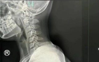 低头族注意了！9岁女孩长期低头颈椎老如50岁