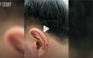 团购低人一等？男子理发耳朵被剪掉一块肉：店方求网友高抬贵手