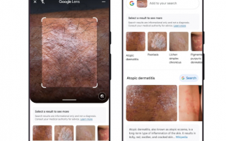 谷歌推出多项功能：识别皮肤病、模拟试穿衣服