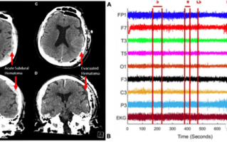 科学家意外记录人类“濒死脑电波”：死亡的一瞬间在想什么？