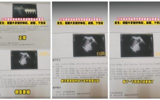 一22岁男生上热搜！常年熬夜 患感冒后查出尿毒症