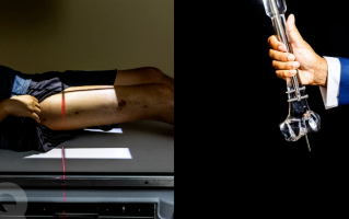 硅谷男工程师青睐增高术？花一辆特斯拉的钱只为增高 7cm