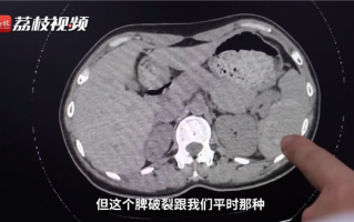 女子摔伤一周后发现脾破裂险丧命！医生提醒：意外受伤要及时检查