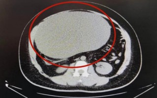 女子以为发胖肚中取出16斤囊肿 比足球大！医生称若局部膨隆要重视